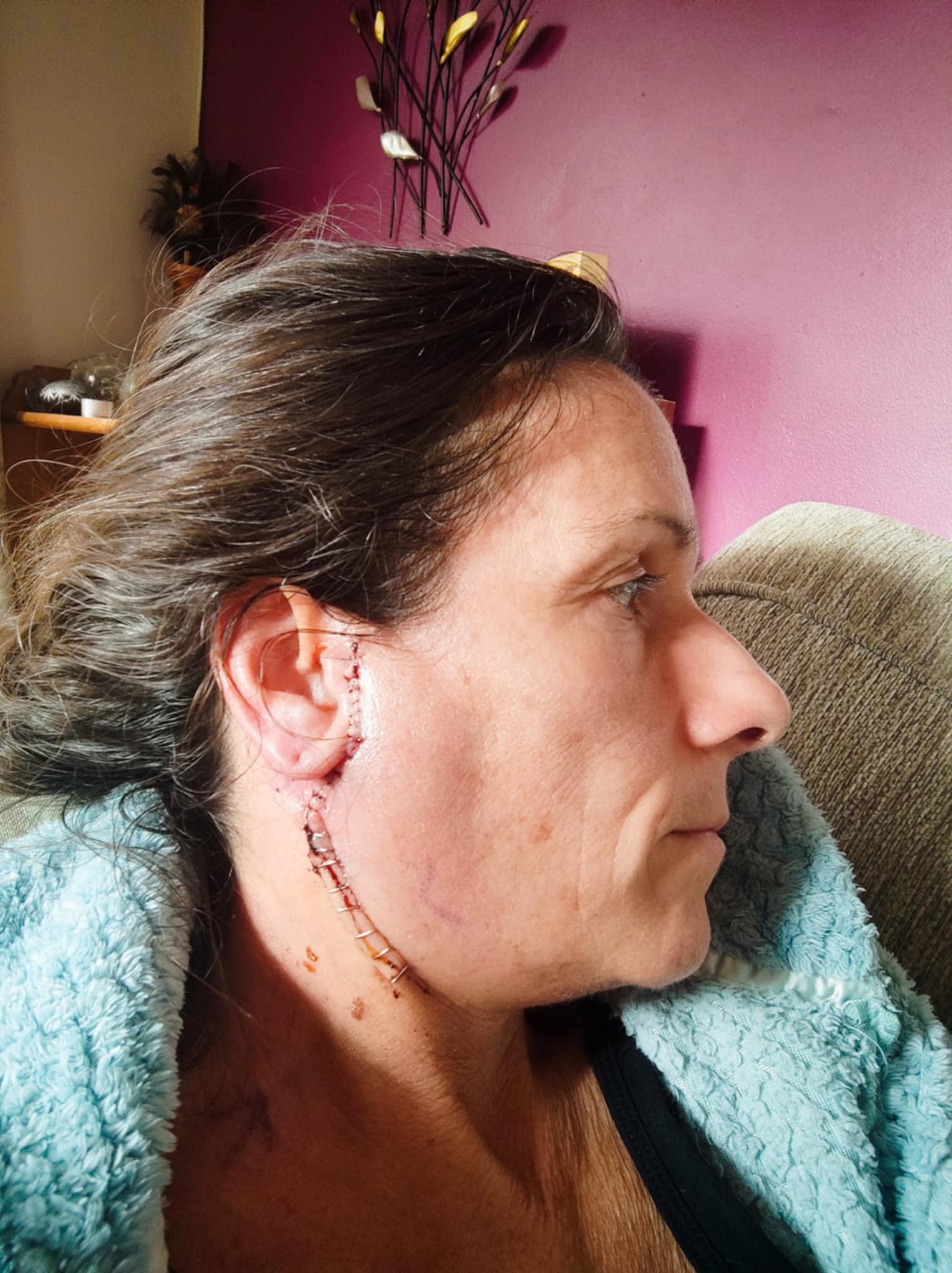 Lisa at home showing surgical scar with stitches during early recovery