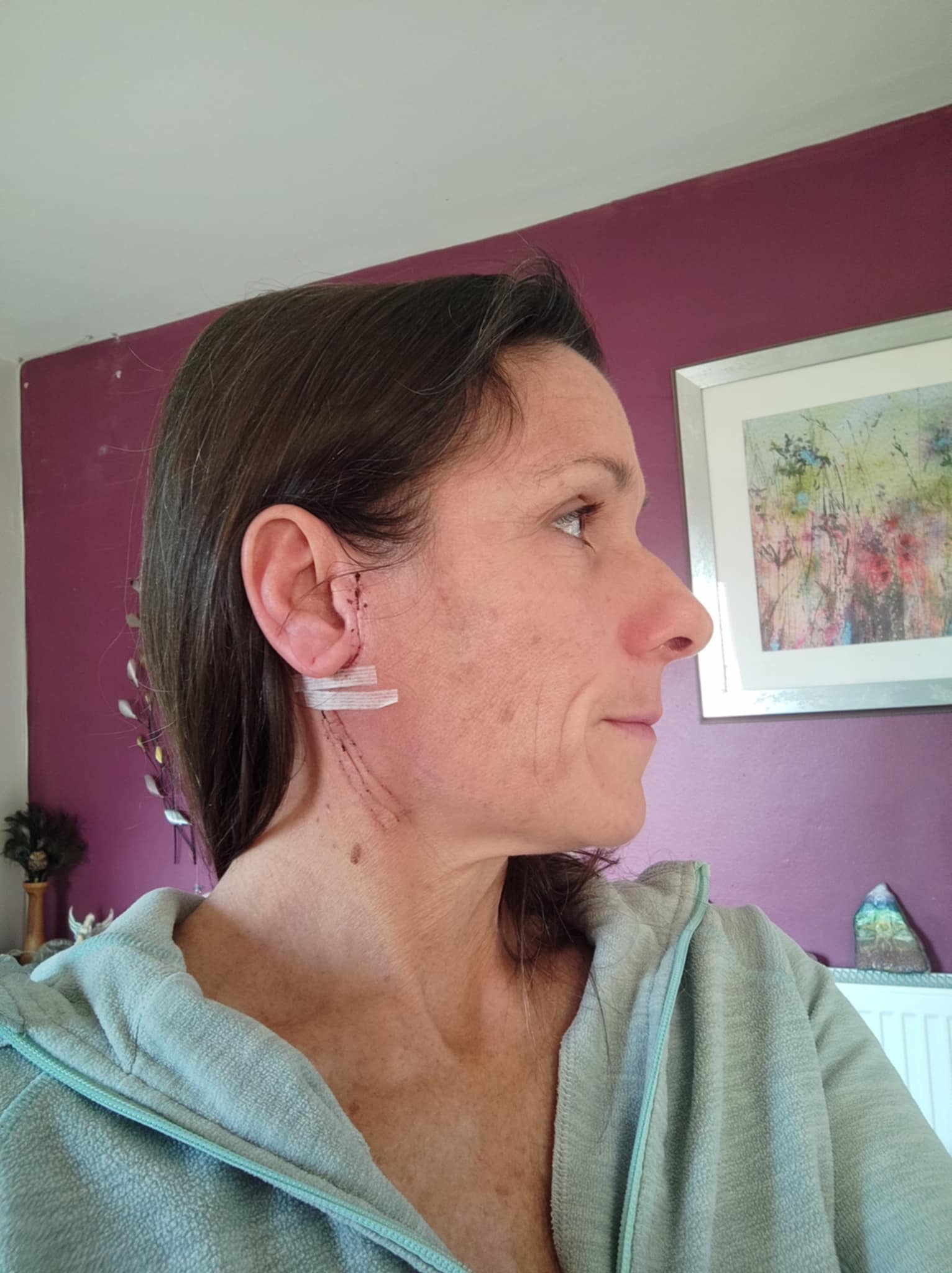 Lisa's surgical scar healing, showing progress